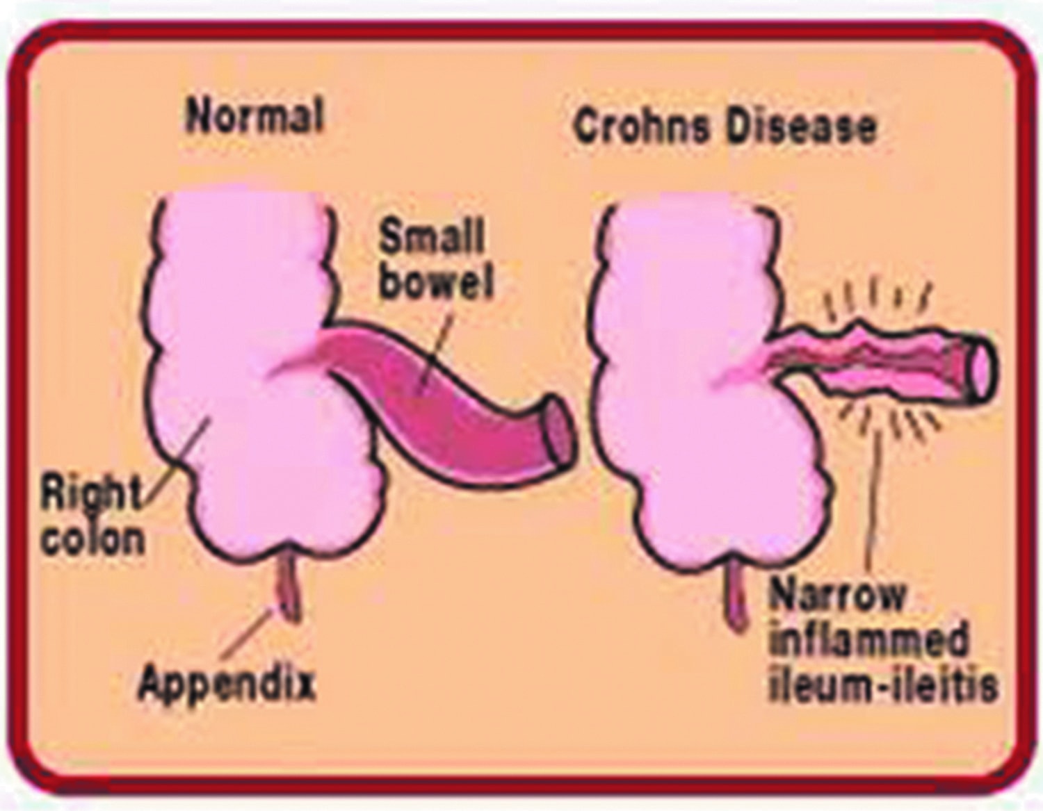 Crohn’s Disease Digestive Tract Disorder HOME TIMES
